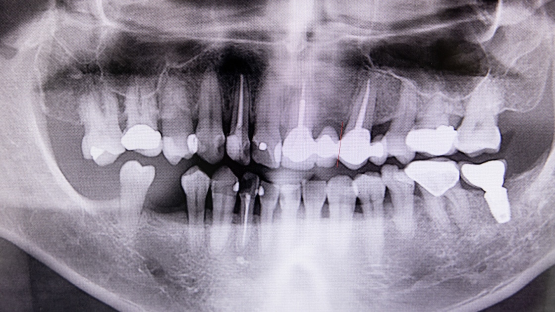 Bone Grafting