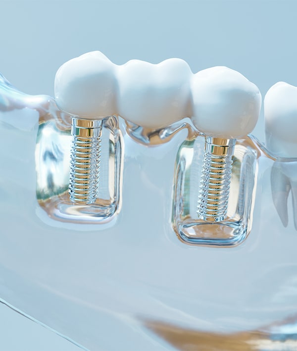 Dental Implants