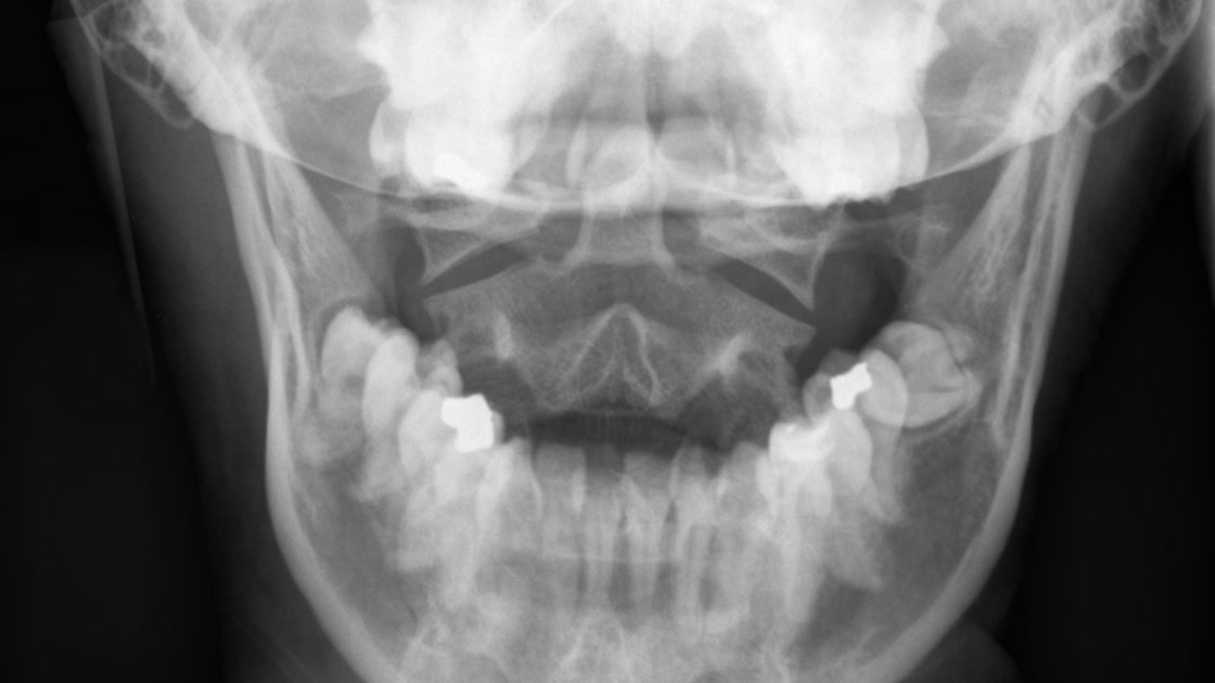 Facial Trauma xray