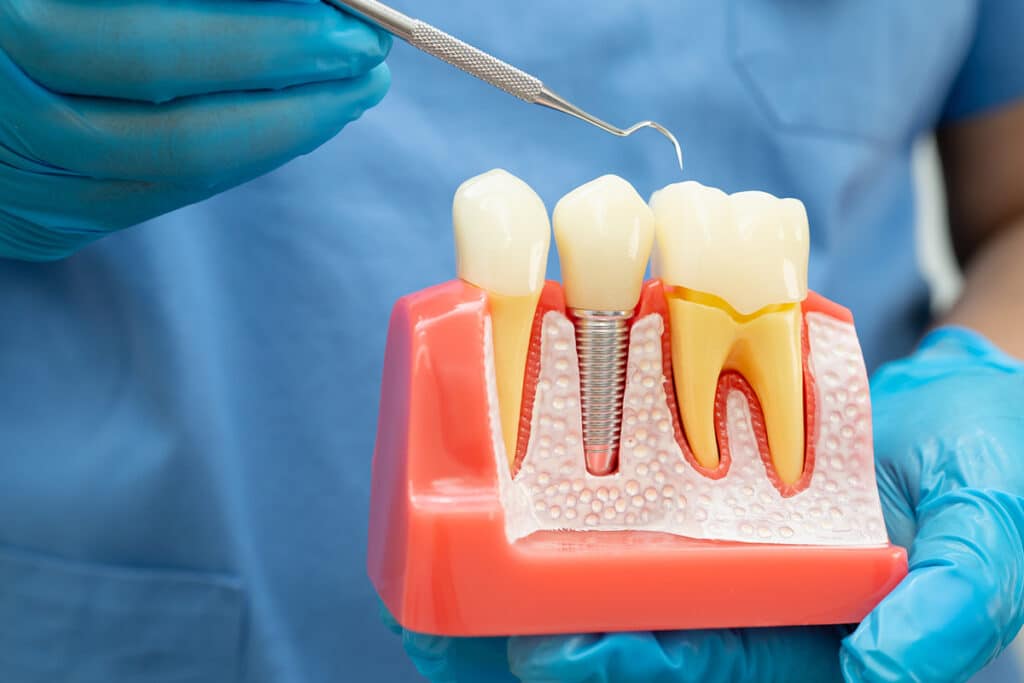 How Dental Implants Help Prevent Bone Loss After Tooth Loss