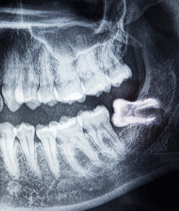 wisdom teeth image